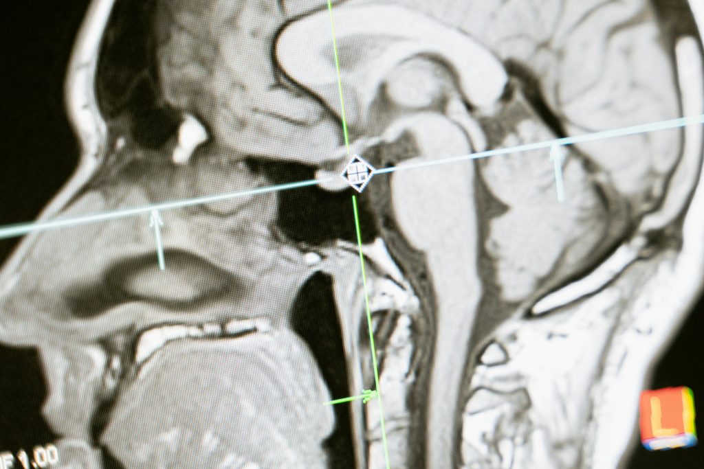 Scanner normal : est-ce vraiment rassurant ?