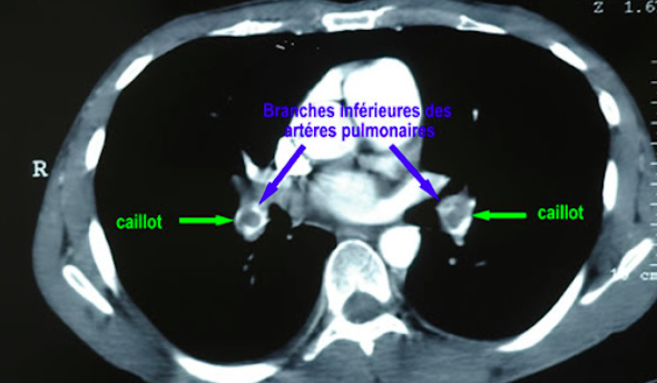 embolie pulmonaire