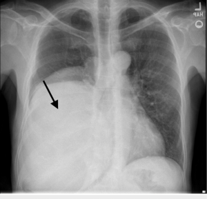 Opacité (radiographie) - expliquemonimagerie.com