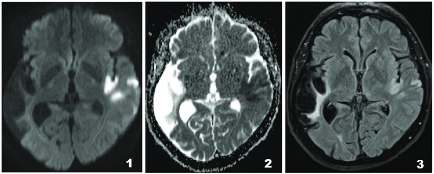 Infarctus cérébral