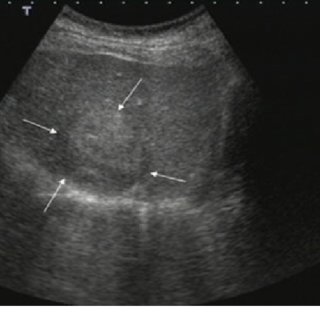 isoechogene