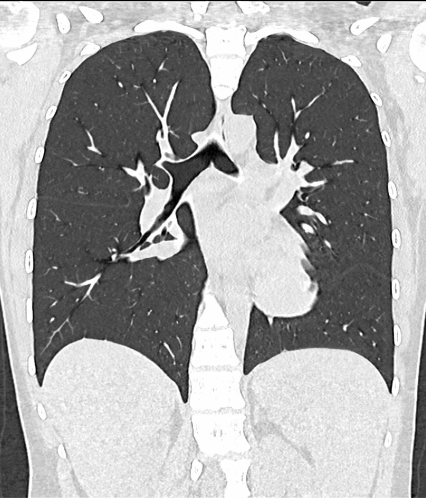 thorax