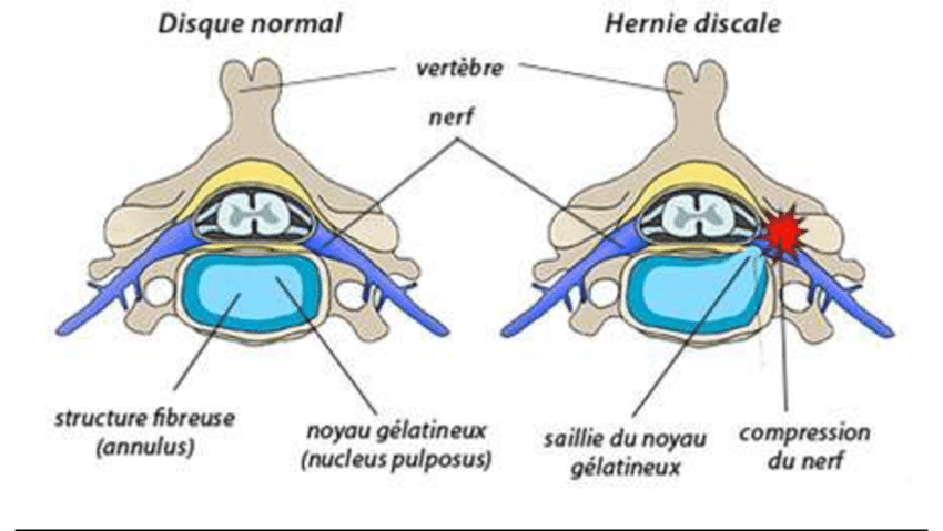Hernie discale