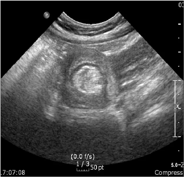 hyperechogene
