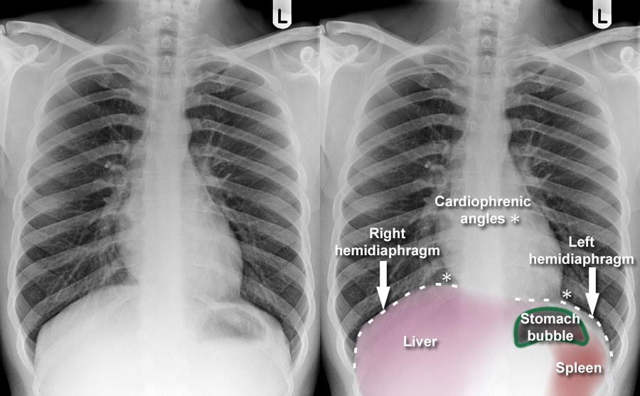 signe du diaphragme