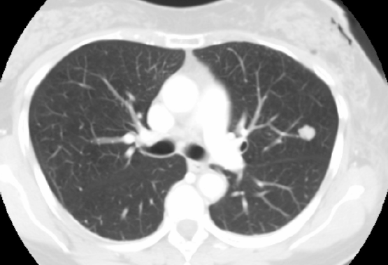 nodule