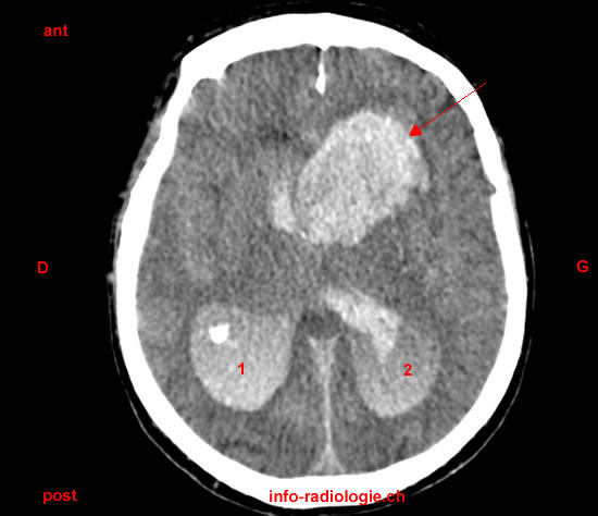 hémorragie intracrânienne
