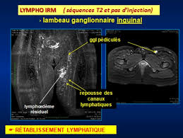 ganglion lymphatique