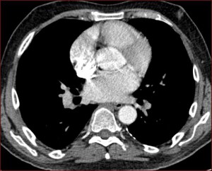 hyperdensité