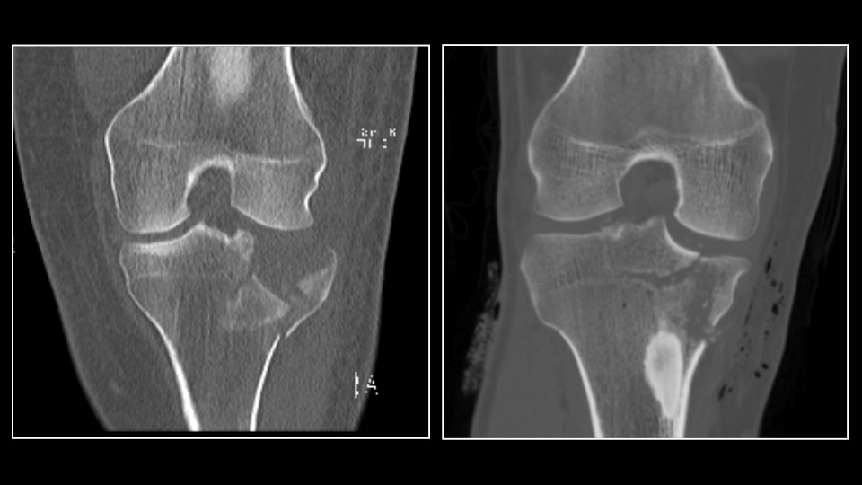 fracture
