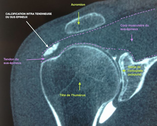 calcification