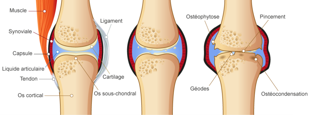Articulation arthrosique