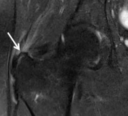 Tendinopathie du moyen fessier sous IRM
