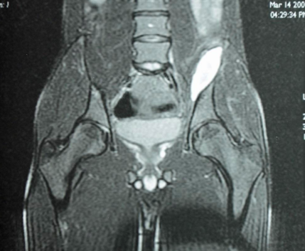 hématome jonction myotendineuse ilio-psoas sous IRM