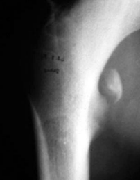Arrachement petit trochanter en radiographie 