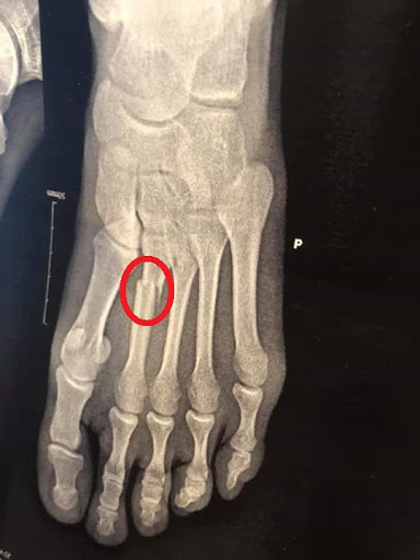 fracture pieds
