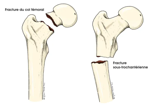 fractures