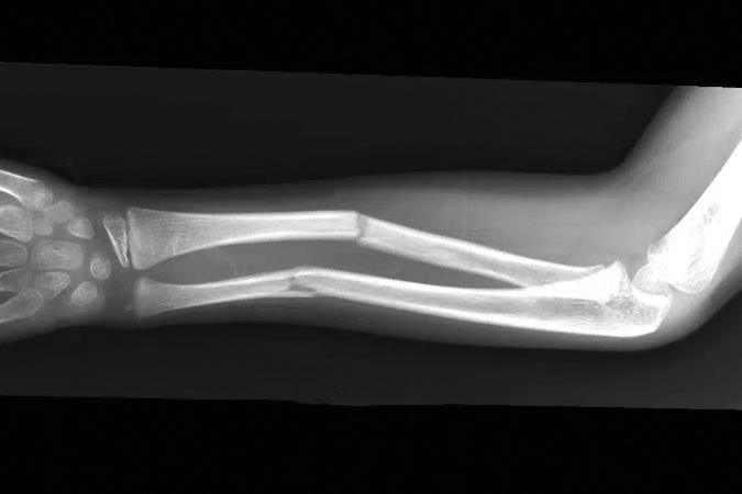 Fractures