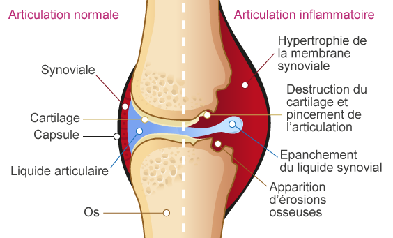 Articulation inflammatoire
