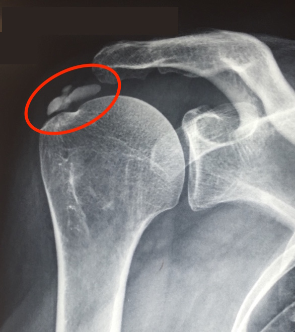 calcification radiographie supra-épineux