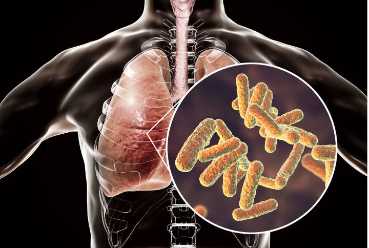 pathologie infectieuse pulmonaire