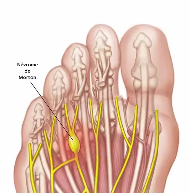 syndrome de morton