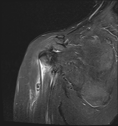 Tendinite calcifiante tendon du long biceps 