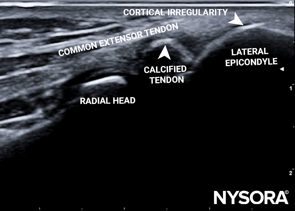 Tennis elbow sous echographie