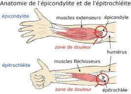 épitrochléite