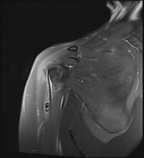 Tendinite calcifiante tendon du long biceps 