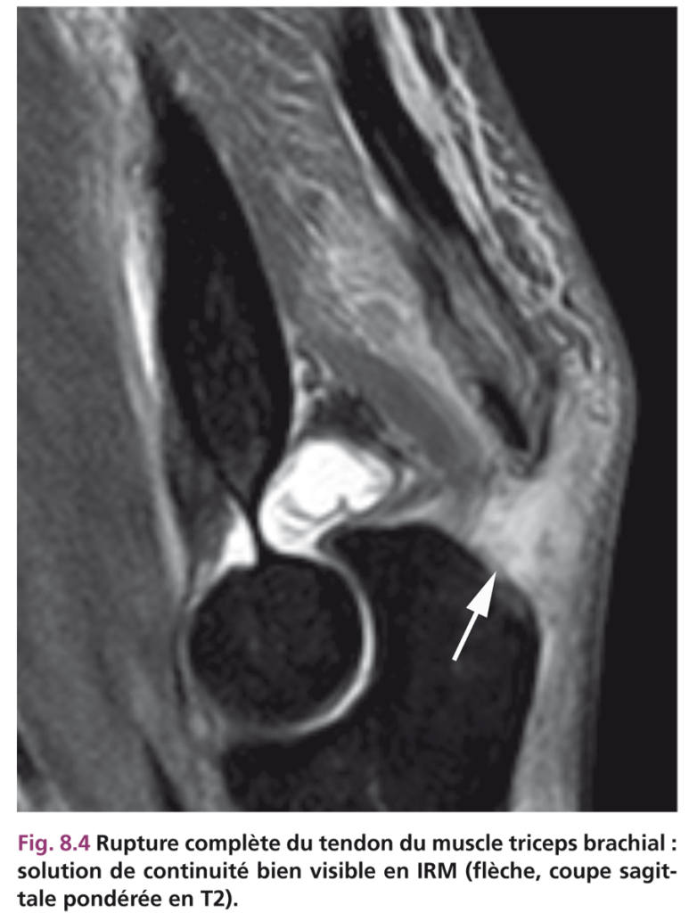 rupture triceps brachial