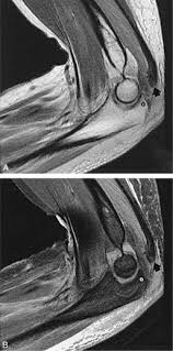 tendinite triceps brachial 