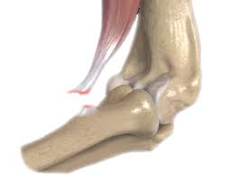 rupture biceps brachial insertion distale