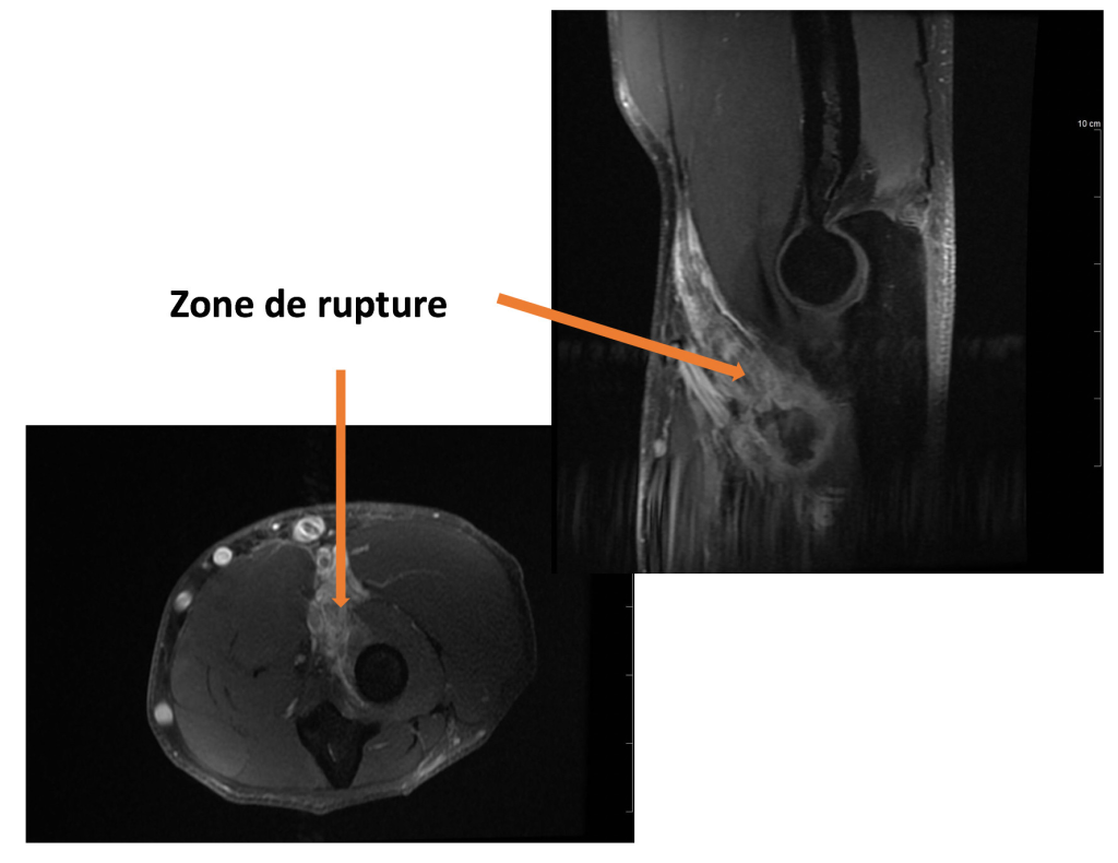 rupture totale du tendon distal du biceps brachial 