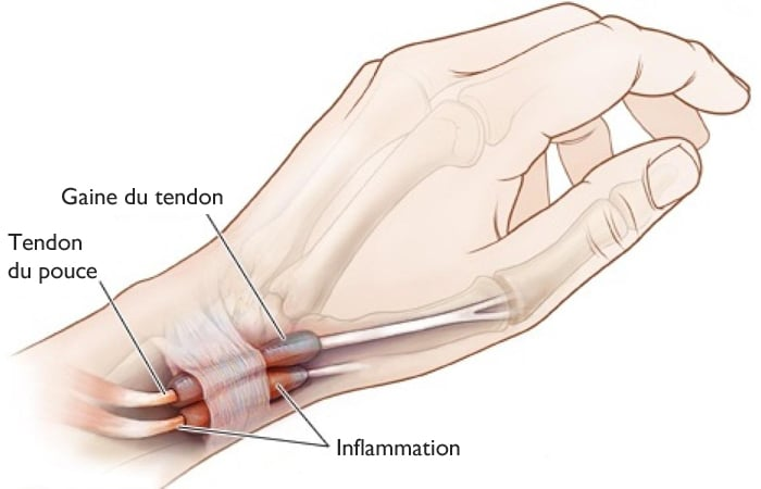 Tendinite de De Quervain 