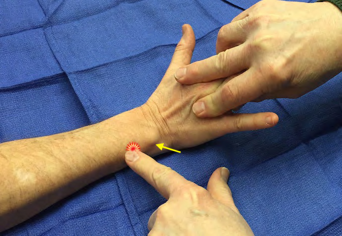 Extenseur ulnaire du carpe 