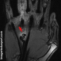 Rupture tendon fléchisseur des doigts 