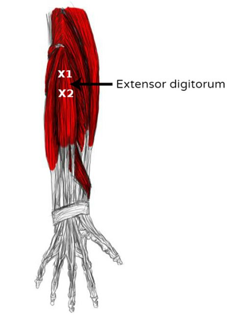 Extenseur des doigts