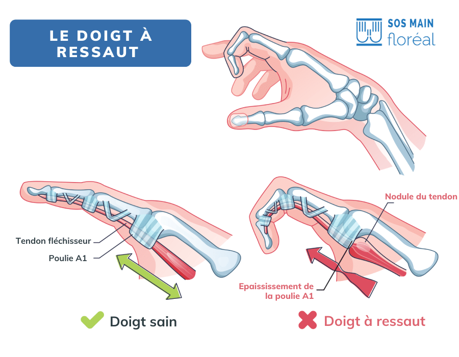 doigt à ressaut 
