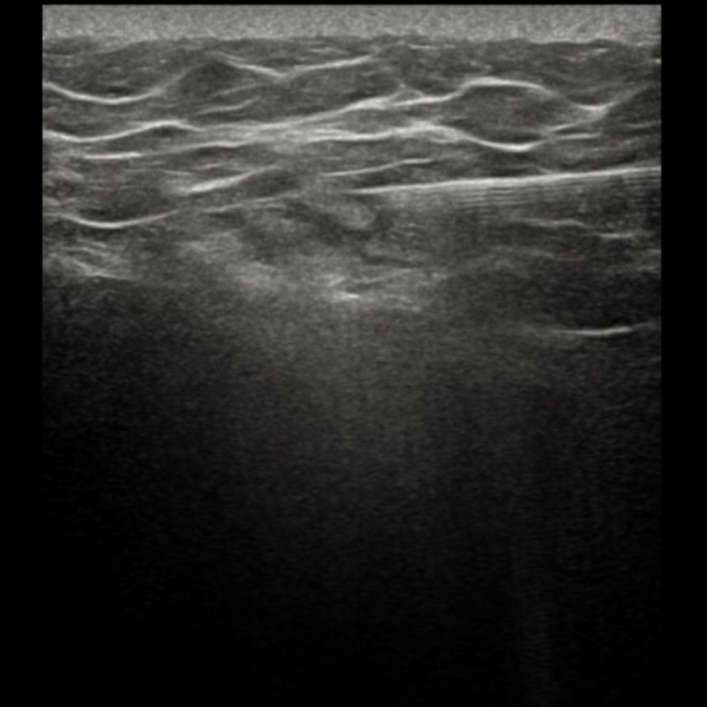 échographie tendinopathie du moyen fessier