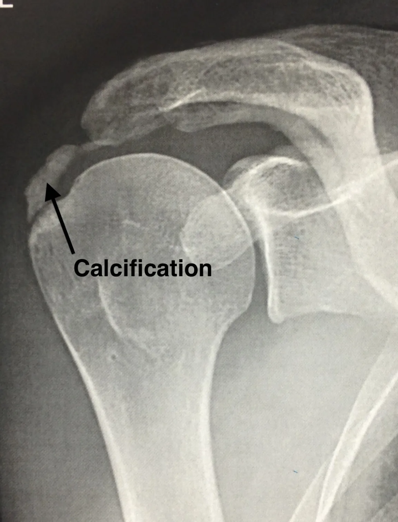 calcification supra-épineux