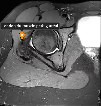 Coupe transversale muscle petit fessier sous IRM