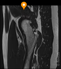 muscle petit fessier IRM