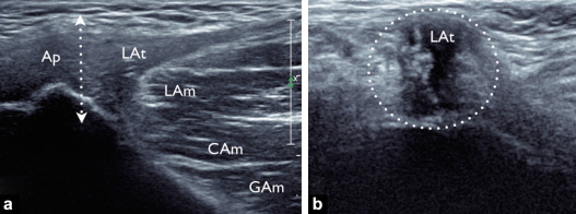 échographie adducteurs tendinopathie