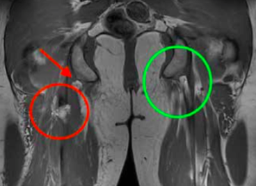 Lésion tendon haut des ischio-jambiers sous IRM