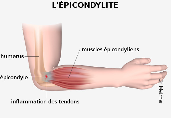 épicondylite latéral