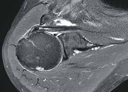 lésion partielle interstitielle du tendon subscapulaire sous coupe transversale d'IRM