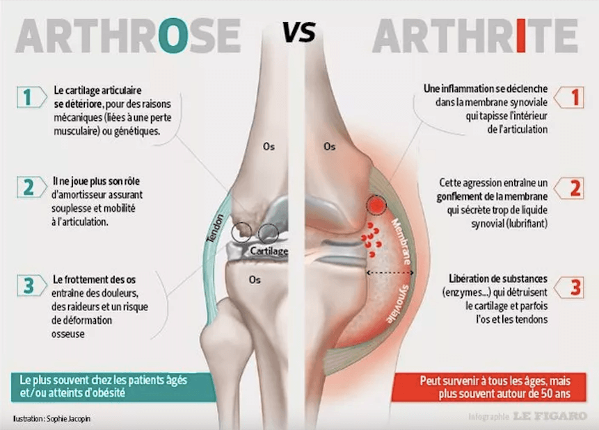 Inflammation articulaire
