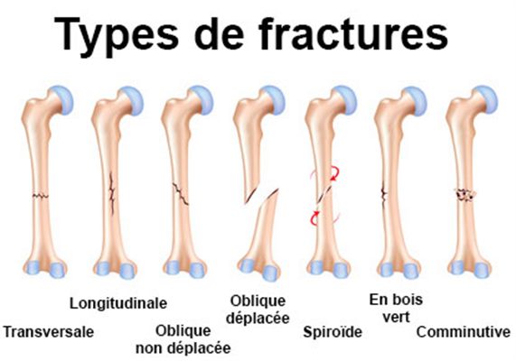 types de fractures
