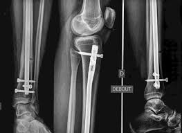 fractures jambe
